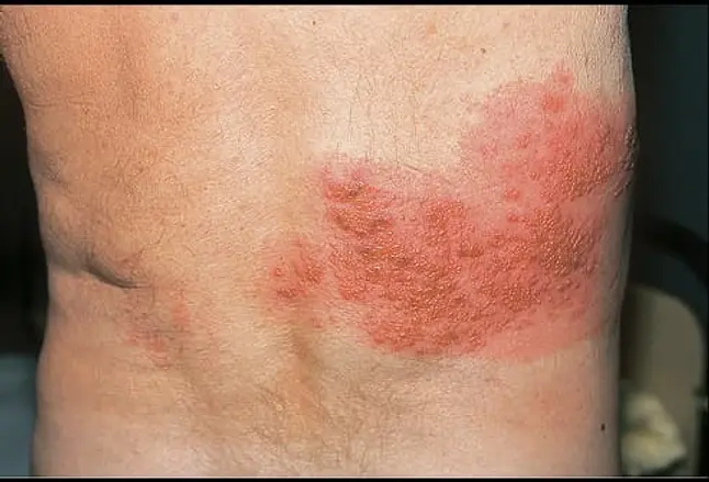 Picture of Varicella-Zoster Virus Infection 