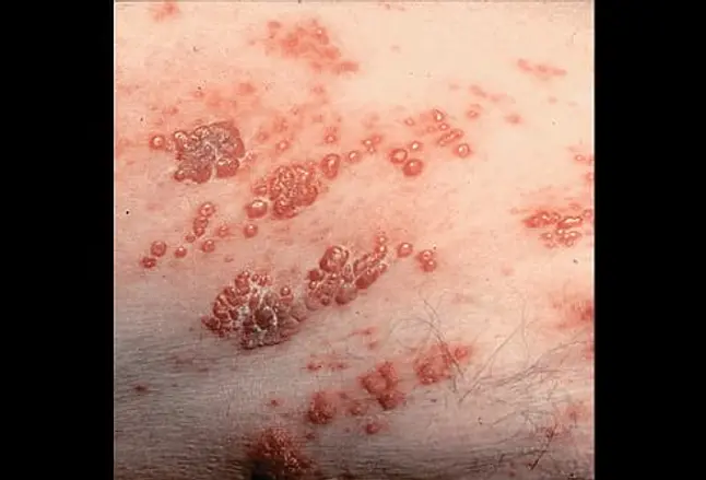 Picture of Varicella-Zoster Virus Infection