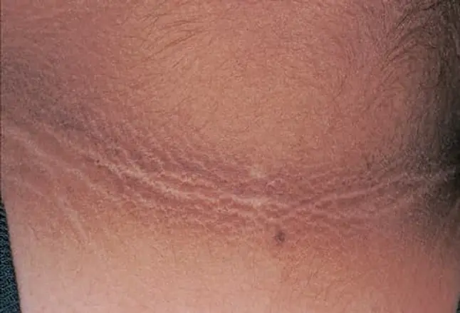 Picture of Acanthosis Nigricans 