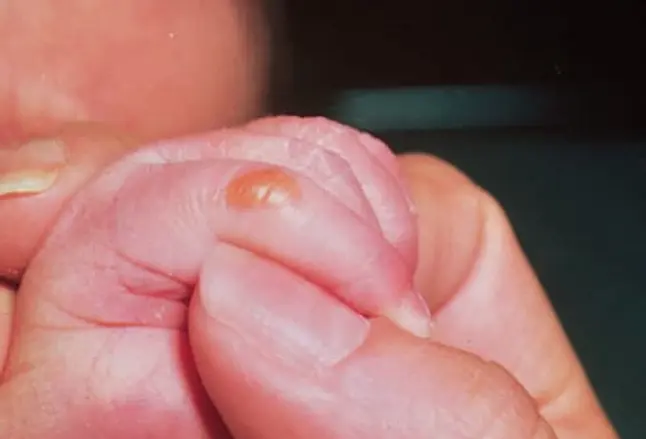 Picture of Sucking Blister