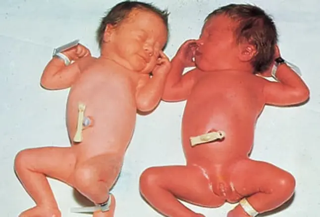 Picture of Twin-to-Twin "Transfusion"