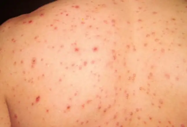 Picture of Varicella Chickenpox 