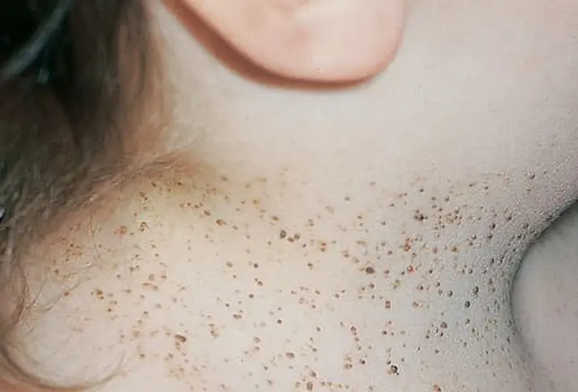 Picture of Basal Cell Nevus Syndrome