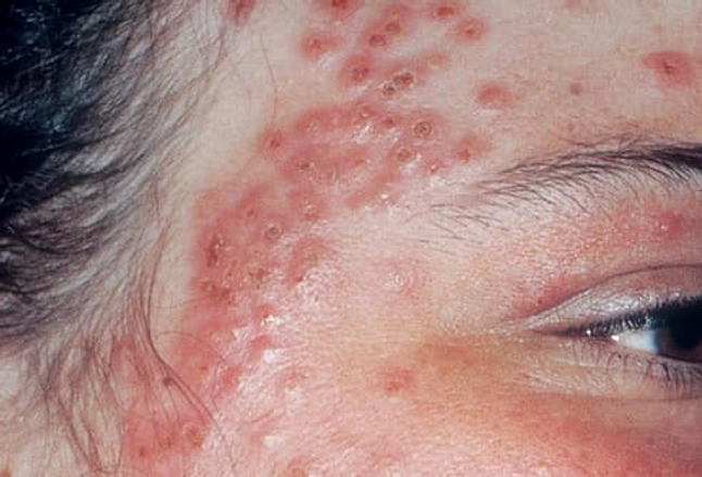 Picture Of Eczema Herpeticum