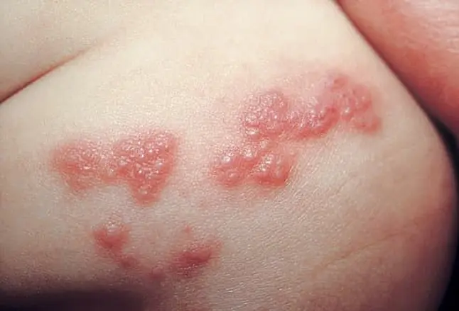 Picture of Herpes Zoster