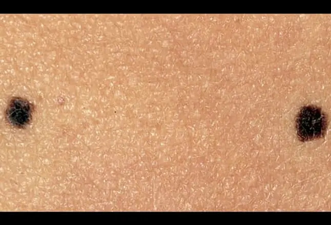 Picture of Junctional Nevus