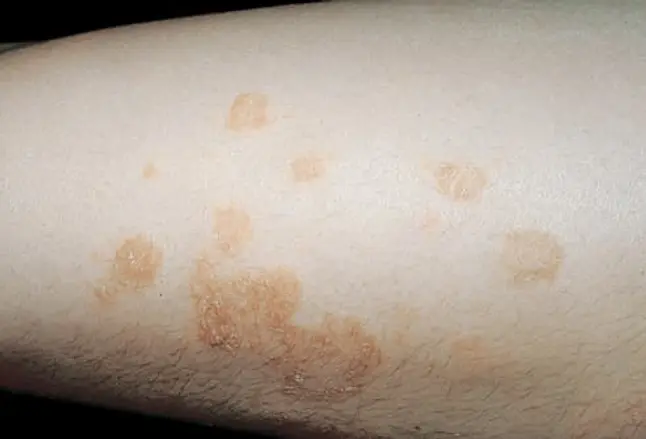 Picture of Nummular Eczema