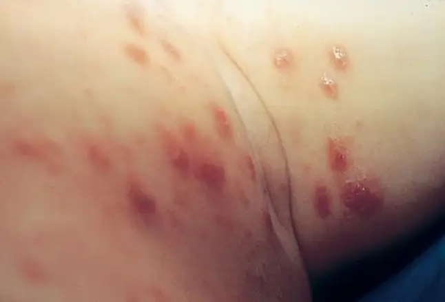 Picture of Scabies