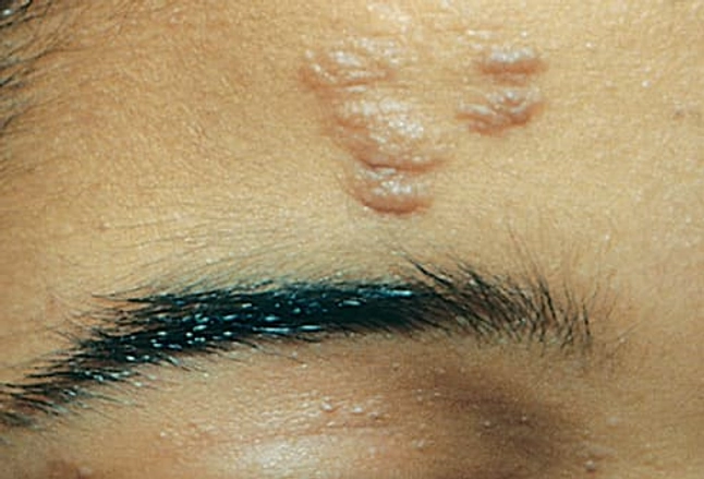 Picture of Tuberous Sclerosis (Fibrous Plaque)