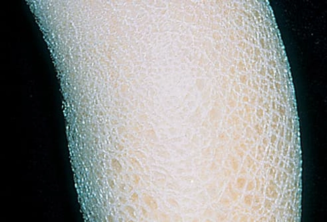 Picture Of X Linked Ichthyosis