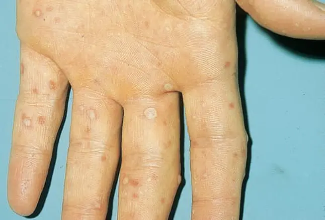 Picture of Hand-Foot-and-Mouth Disease on Hand