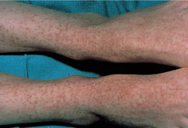 Picture of Rocky Mountain Spotted Fever on Ankles