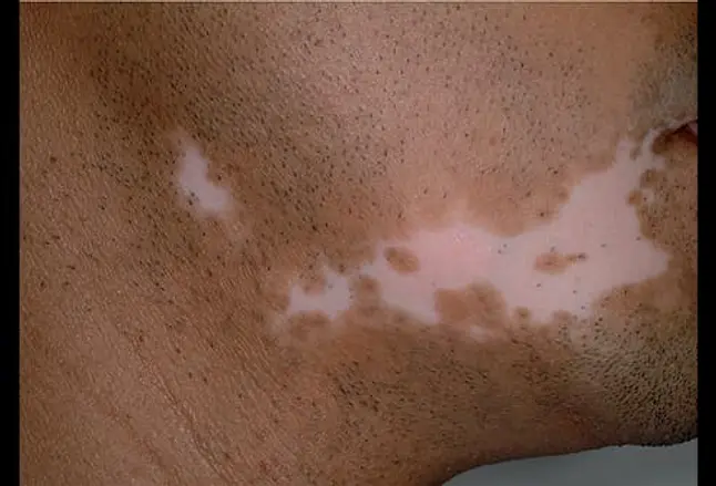 Picture of Depigmented Patch of Skin