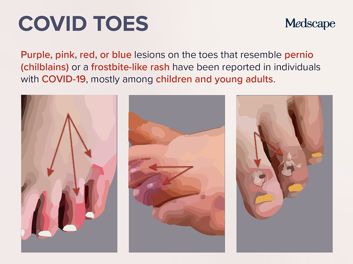 COVID toes infographic