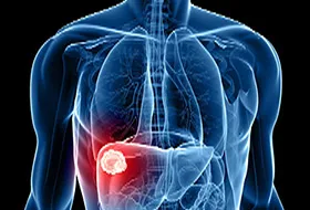 Metastatic cancer of the liver treatment