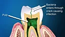 illustration of tooth infection