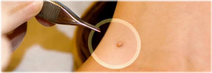 Skin Tags Quiz: Causes, Dangers, and Removal of Skin Tags
