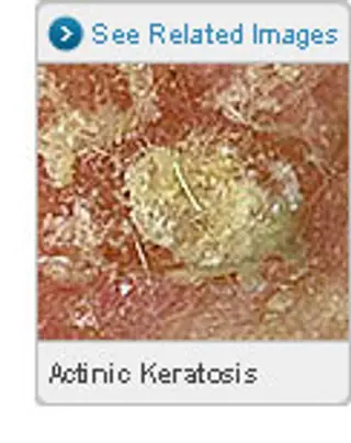 Picture of Actinic Keratosis (Solar Keratosis)