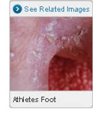 Picture of Athlete's Foot