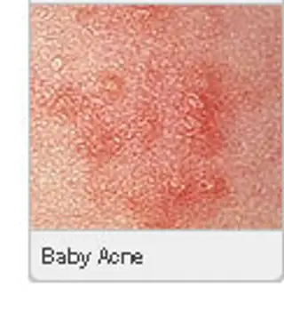 Picture of Baby Acne