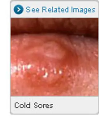 Picture of Cold Sores (Fever Blisters)