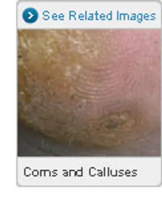 Picture of Corns and Calluses