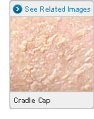 Picture of Cradle Cap