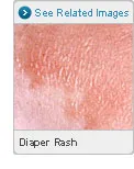 Picture of Diaper Rash