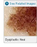 Picture of Dysplastic Nevi Close-Up