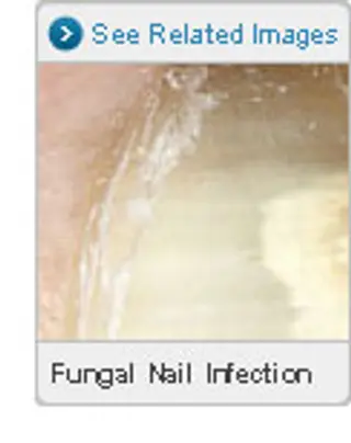 Picture of Fungal Nail Infections
