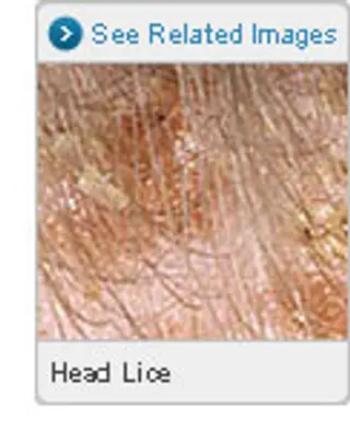 Picture of Head Lice