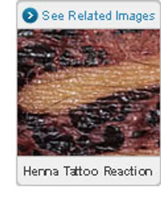 Picture of Henna Tattoo Reactions