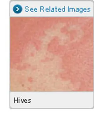 Picture of Hives (Urticaria)