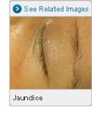 Picture of Jaundice