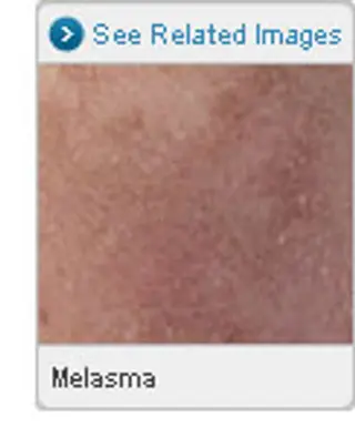 Picture of Melasma 
