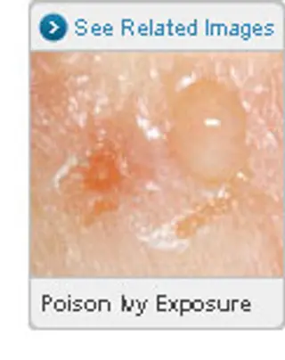 Picture of Rash from Poisonous Plants