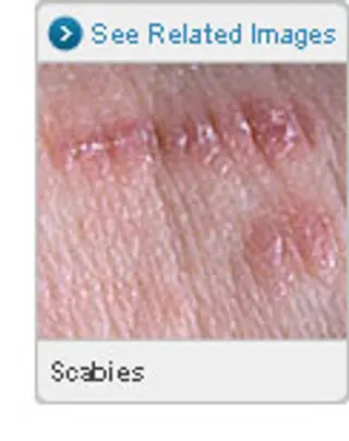 Picture of Scabies