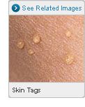 Picture of Skin Tags