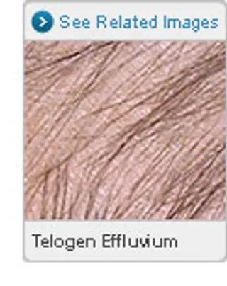 Picture of Telogen Effluvium 