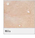 Picture of White Bumps (Milia)