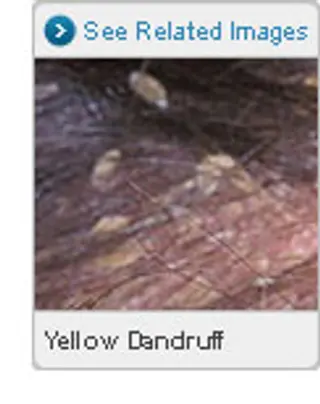 Picture of Yellow Dandruff