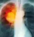 lung cancer overview slideshow