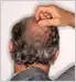Mens Hair Loss When To Start Treatment
