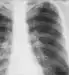 Bronchitis Overview