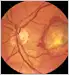 What Is Macular Degeneration