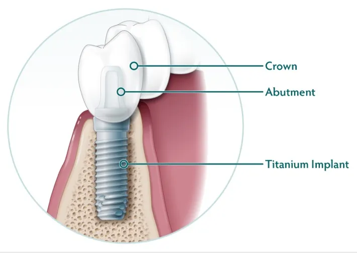 components of dental implants