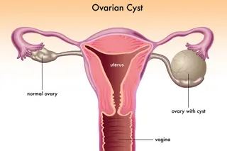 photo of Ovarian cyst
