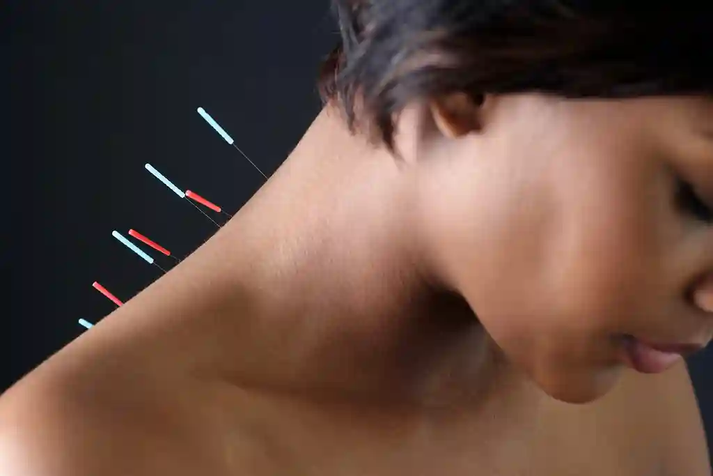photo of acupuncture needles in womans back
