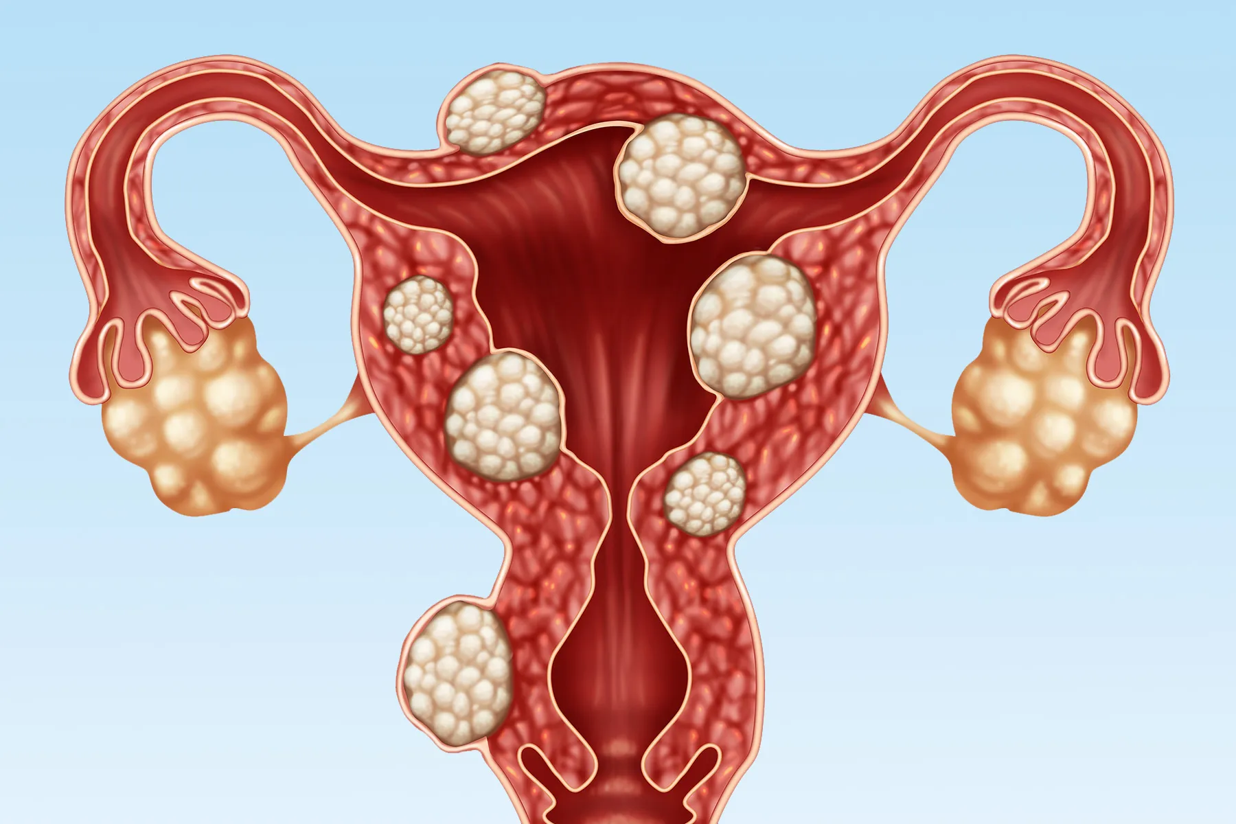 Why Are Uterine Fibroids Particularly Common in Black Women?