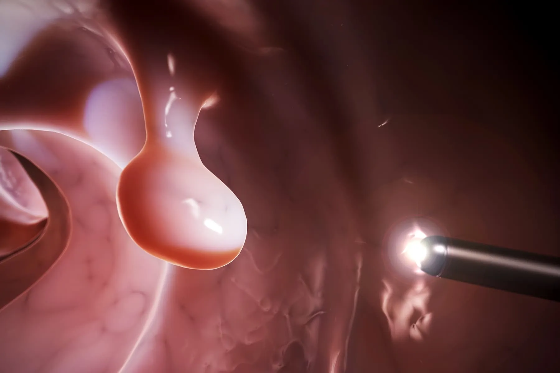 Your Next Colonoscopy Could Get an Assist From AI